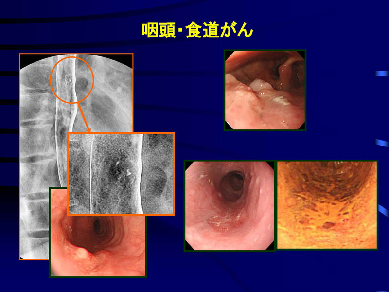 胃がん発見の為の胃カメラ検査の有用性
